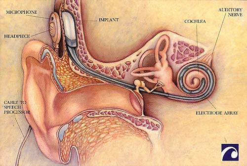 ear implant diagram