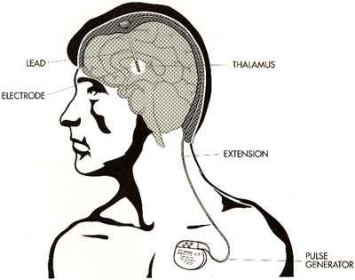 implant diagram